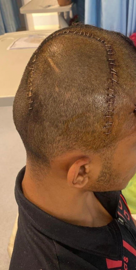 نجاح عملية لشاب  يعاني من نزف فوق غشاء  الدماغ نتي