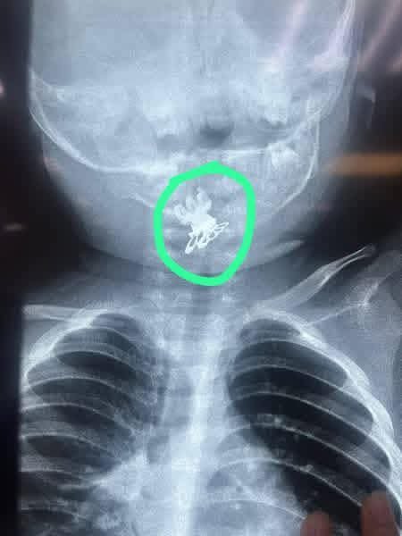 انقاذ حياة طفلة من الاختناق باستخراج جسم غريب من مجرى التنفس في النجف